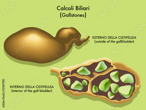 calcoli sintomi colecisti