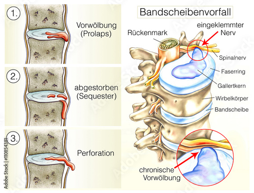 der bandscheibenvorfall