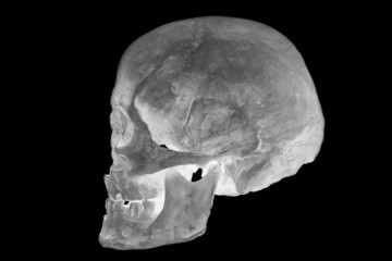 radiographie de crâne