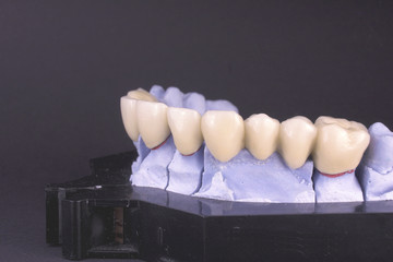 dental bridge