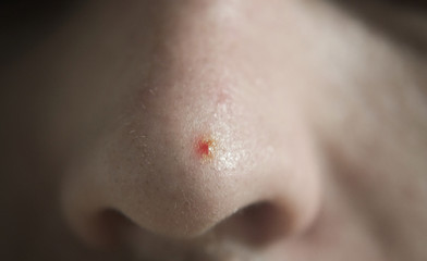 pimple