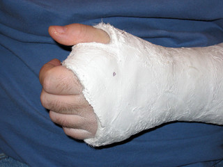broken wrist