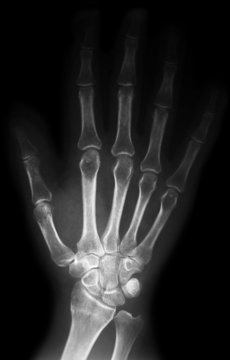 bones of the hand
