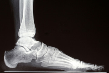 x-ray