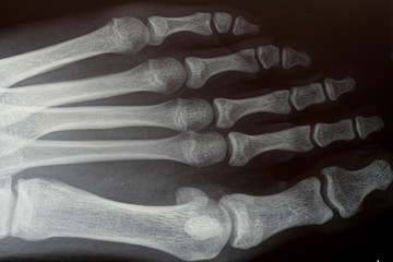 x-ray