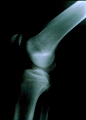röntgenaufnahme knie