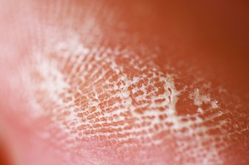 Fototapeta premium callosity finger