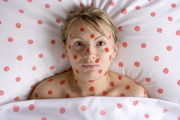 woman with red spots on face and body - obrazy, fototapety, plakaty