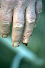 blessure