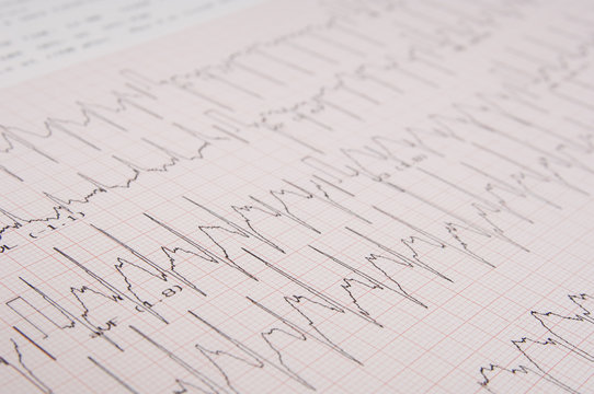 ecg