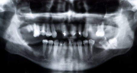 panoramic x-ray picture of a mouth