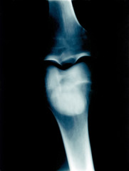 xray &ndash; rodilla 1