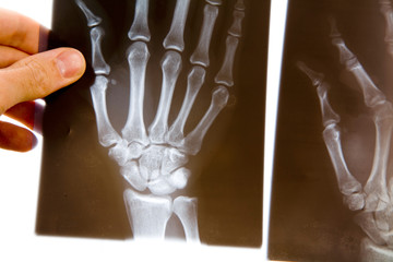 doctor with x-ray of hand