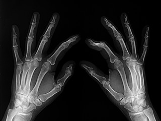 x-rayed hands