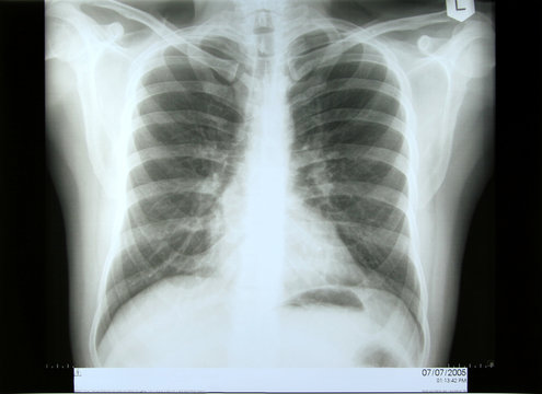 torax xray
