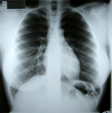 torax xray