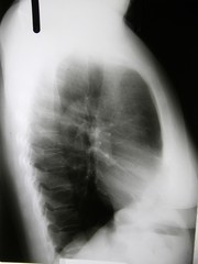xray of lungs and breasts