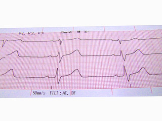 heart rate ecg - 2209979