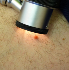 skin cancer checkup