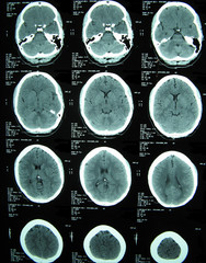 ct brain