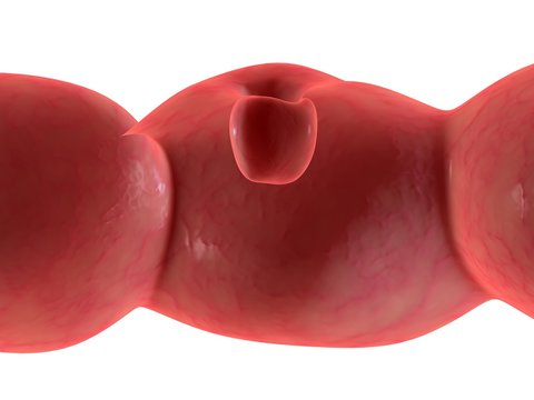 darmtumor