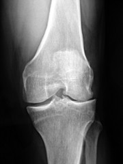 arthrose femorau tibial externe genou