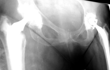 hip replacement