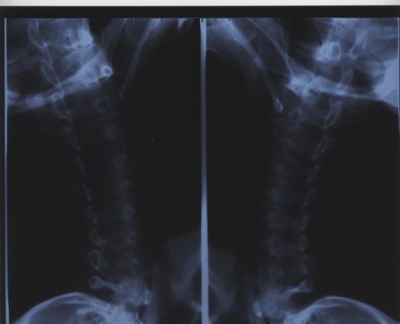 radiographie des vert&eacute;bres cervicale