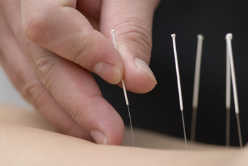 treatment by acupuncture - obrazy, fototapety, plakaty