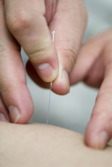 treatment by acupuncture