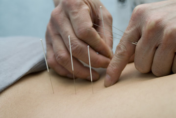 treatment by acupuncture