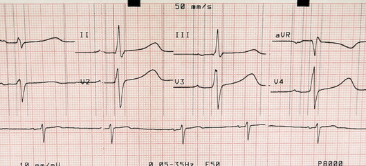 ecg