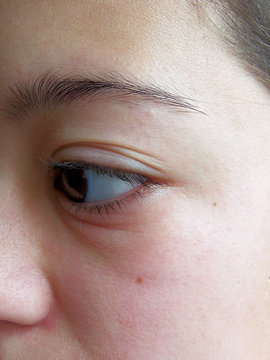 Girl With Swollen Eye / Crying / Allergy