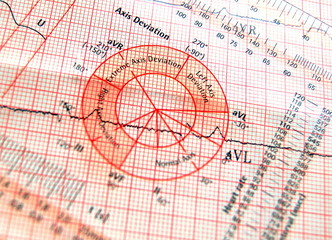 ecg axis