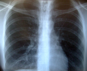 röntgen