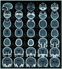 magnetic resonance scan of brain