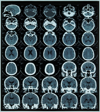 magnetic resonance scan of brain