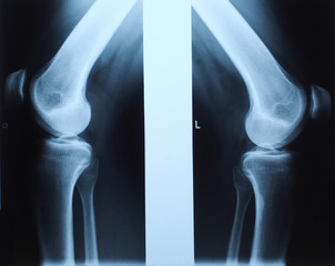 x ray photo of human knee