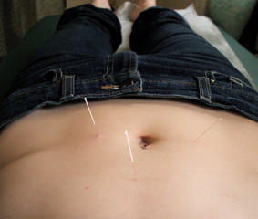 Needles in Stomach During Acupuncture Appointment