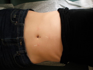 Needles in Stomach During Acupuncture Appointment