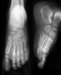 Front and side view of foots on x-ray film