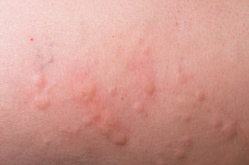 An allergic reaction causeing a severe case of hives.
