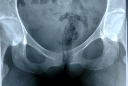 X-ray of Pelvis