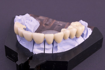 Dental bridge at laboratory