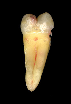 Tooth #18