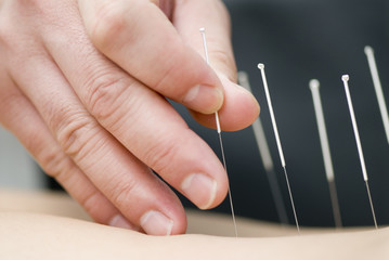 Treatment by acupuncture - obrazy, fototapety, plakaty