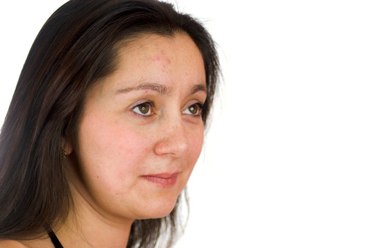 Upset woman with acne