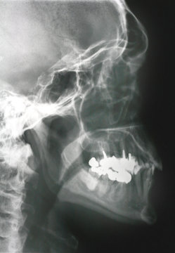 Röntgenbild Kopf