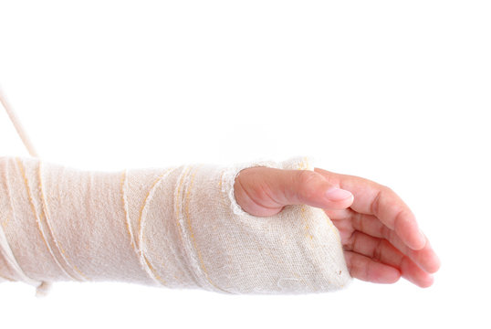 Broken Arm immobilized on white background .