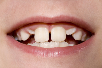 Young Boy's Teeth Closeup